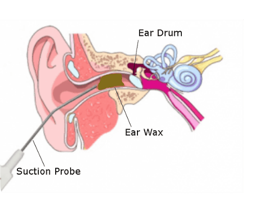 Earwax removal service